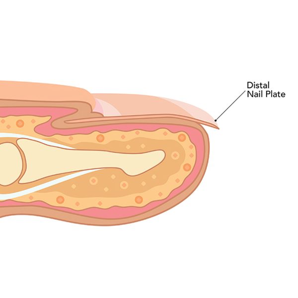 DISTAL NAIL PLATE - GlossaryLive
