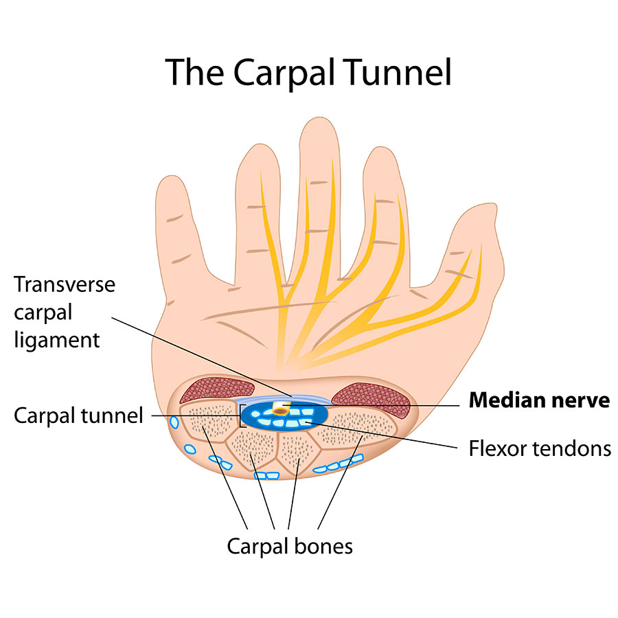 GlossaryLive Glossary Term Carpal Tunnel