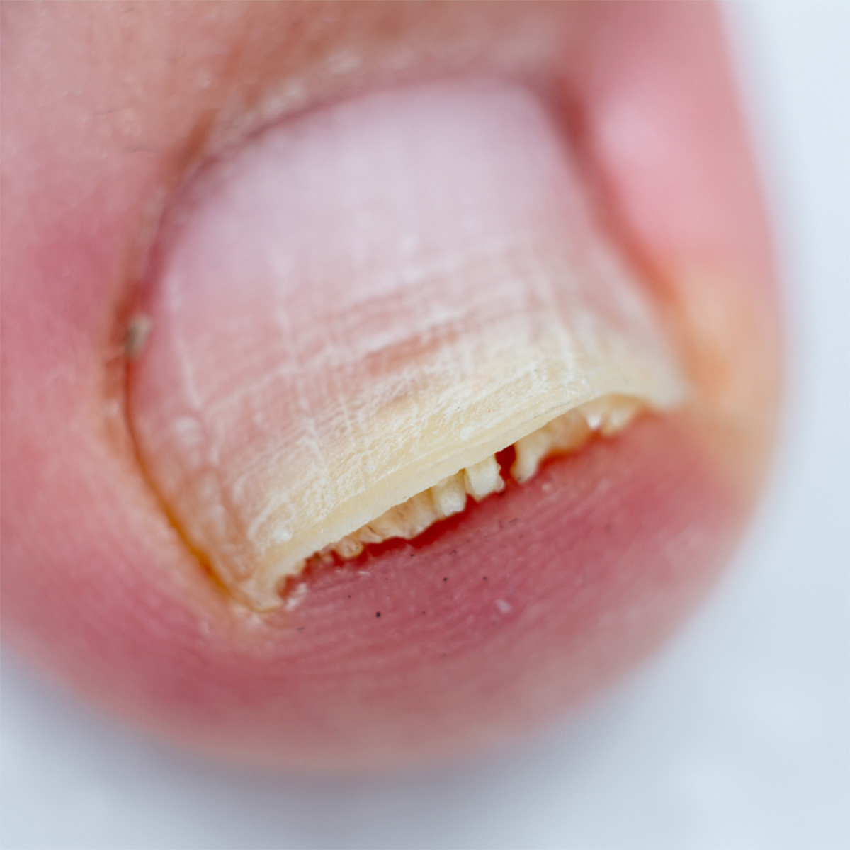 Badly Damaged Nails | Gel Polish Allergy, Nail Plate Burn, Onycholysis -  YouTube